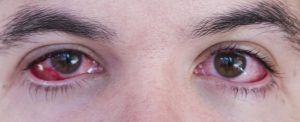 Ojos con conjuntivis
