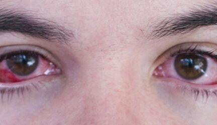Ojos con conjuntivis