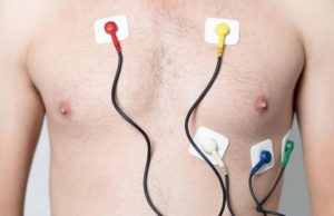 Electrodos del electrocardiograma
